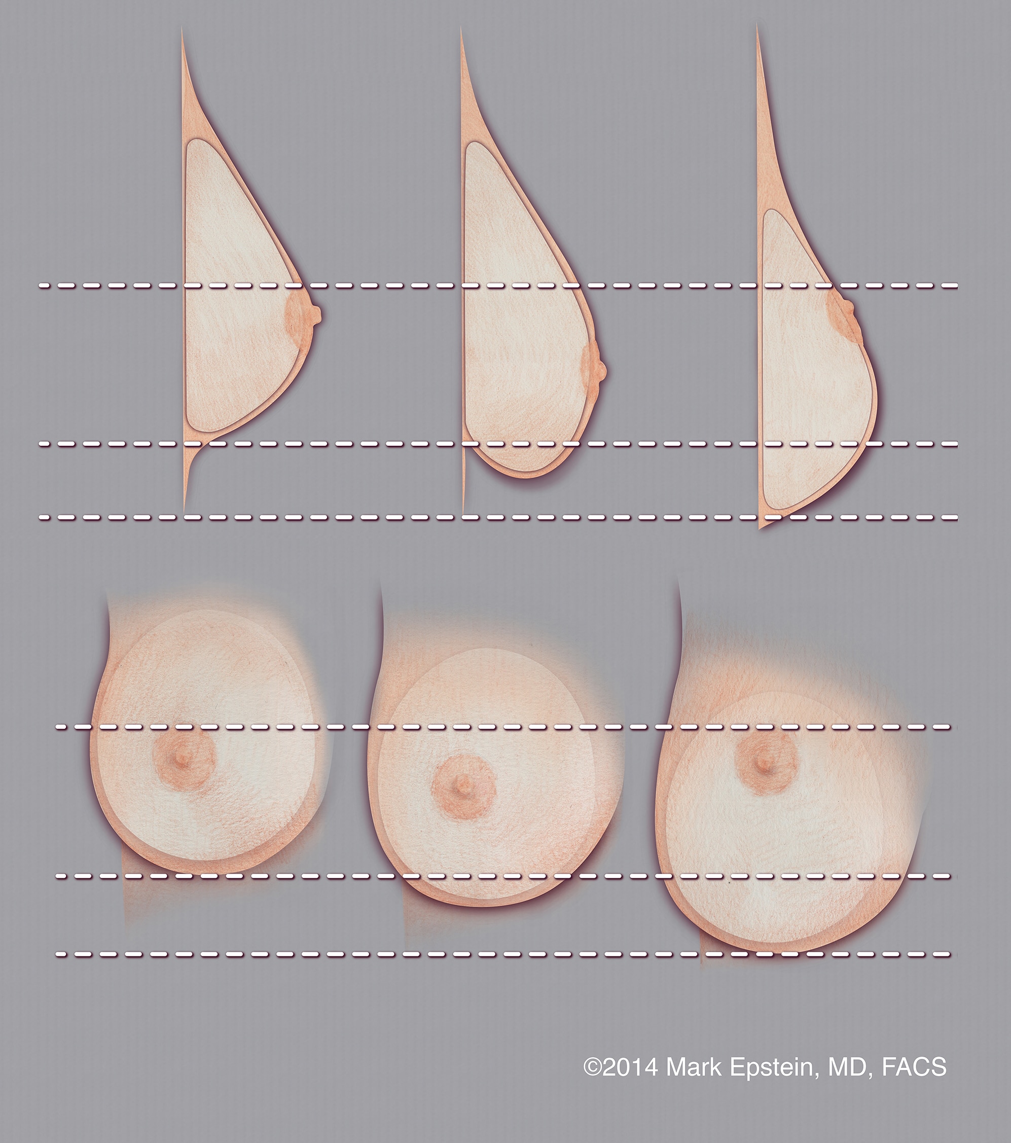 Small pointy breasts- want to fix shape but avoid implants and