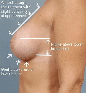 Natural Looking Breast Augmentation Long Island