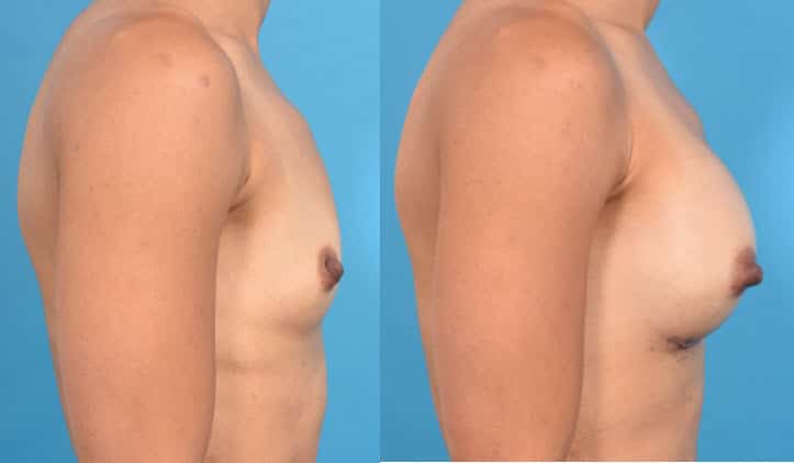 Breast Augmentation Recovery: What to Expect in Post Surgery Healing